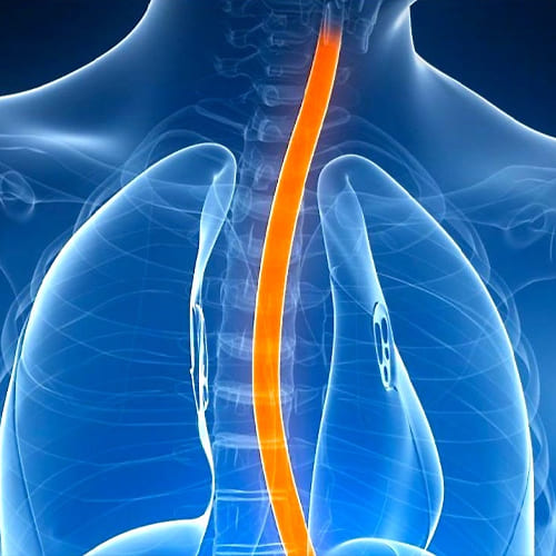 Cirugía de esófago